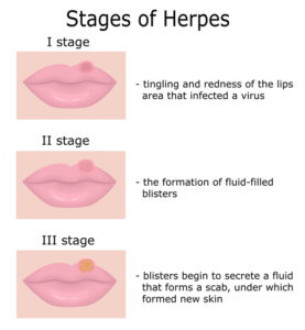 HerpoVeda - New Herpes Cure With the power of Ayurveda