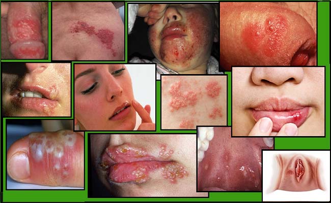herpes-outbreaks