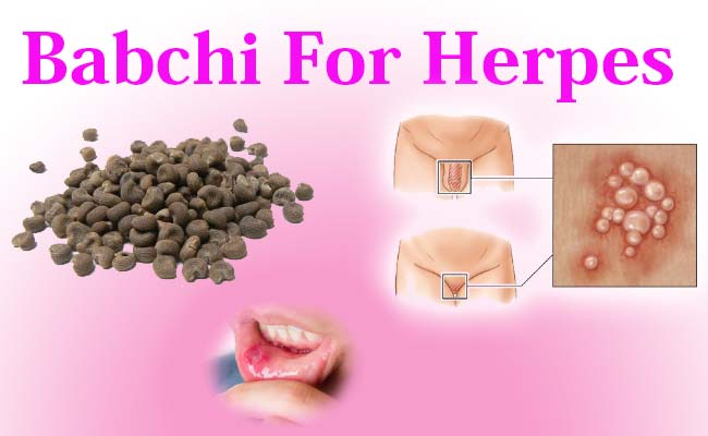 babchi for herpes