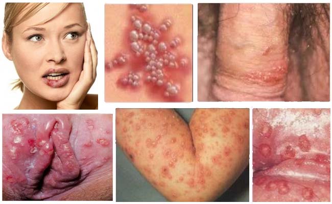herpes outbreaks