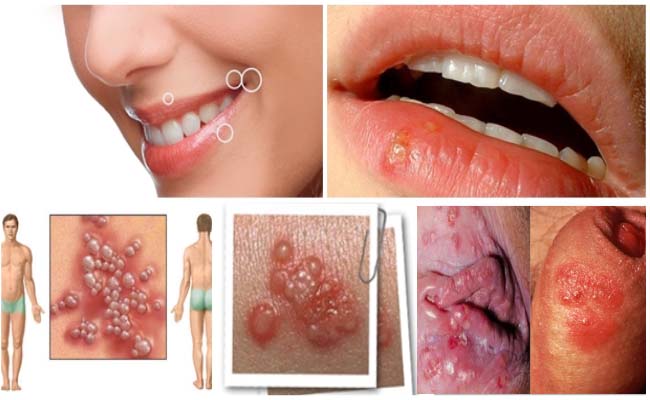 herpes outbreaks