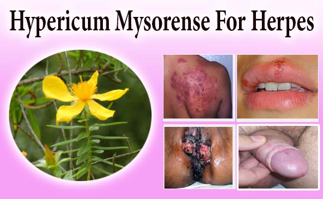 hypericum Mysorense for Herpes
