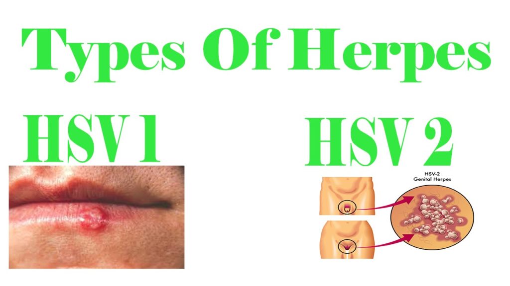 HERPES TYPES DIFFERENT TYPES OF HERPES VIRUSES Herpes Cure